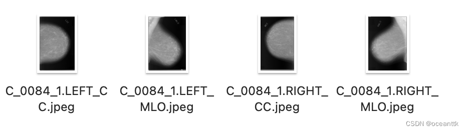 DDSM CT 70 Part 1 oceanttk CSDN 