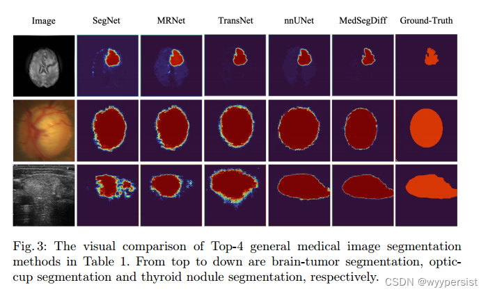 《MedSegDiff Medical Image Segmentation with Diffusion Probabilistic ...