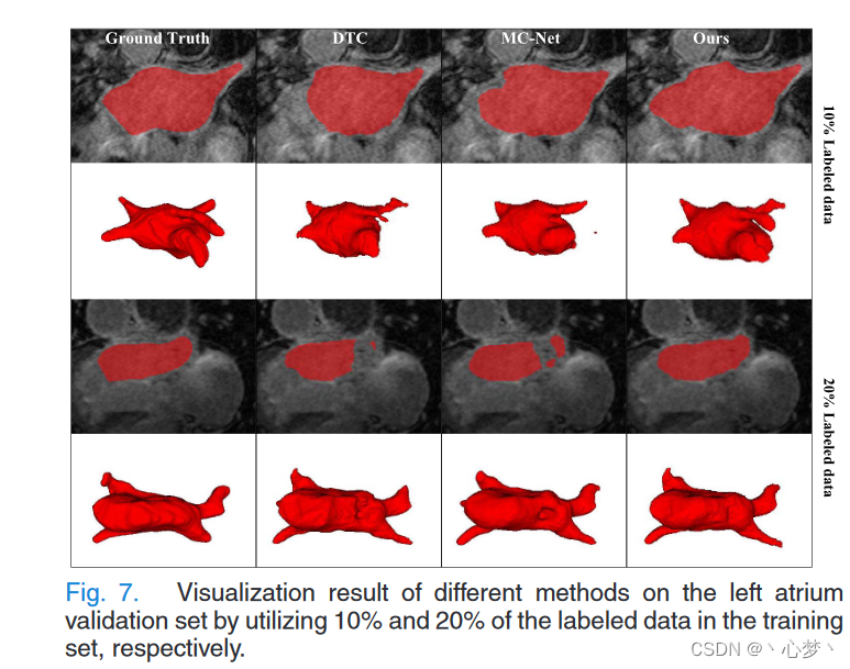 【医学分割】Semi-supervised medical image segmentation network ASE-Net_semi ...