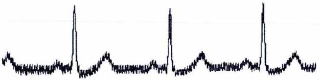 含工频干扰的心电信号