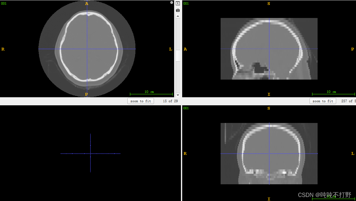 ap,rl,si等c(coronal:冠狀)s(sagittal:矢量面),a(axial:軸向(橫斷)))