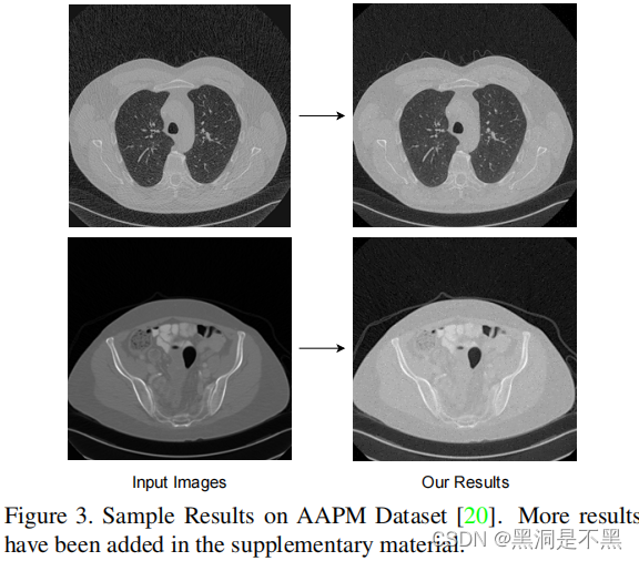 Eformer: Edge Enhancement based Transformer for Medical Image Denoising