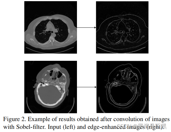 Eformer: Edge Enhancement based Transformer for Medical Image Denoising ...