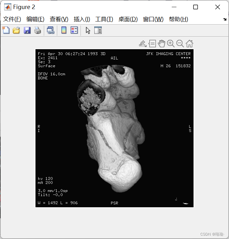 Matlab之DICOM（数字图像和通信医学）格式图像数据读取函数dicomread