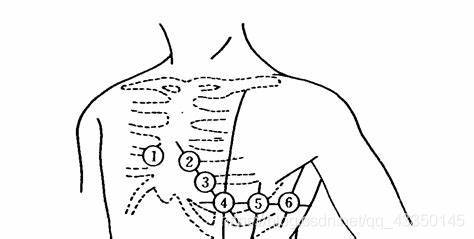 除颤仪四导联位置图片图片