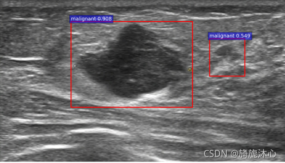 深度学习识别出来的恶性肿瘤 