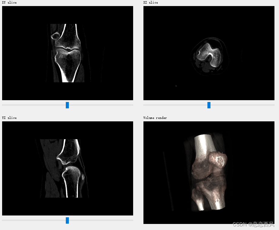 三维重建 医学图像的可视化 PyQt Python VTK 四视图（横断面，冠状面，矢状面，3D）