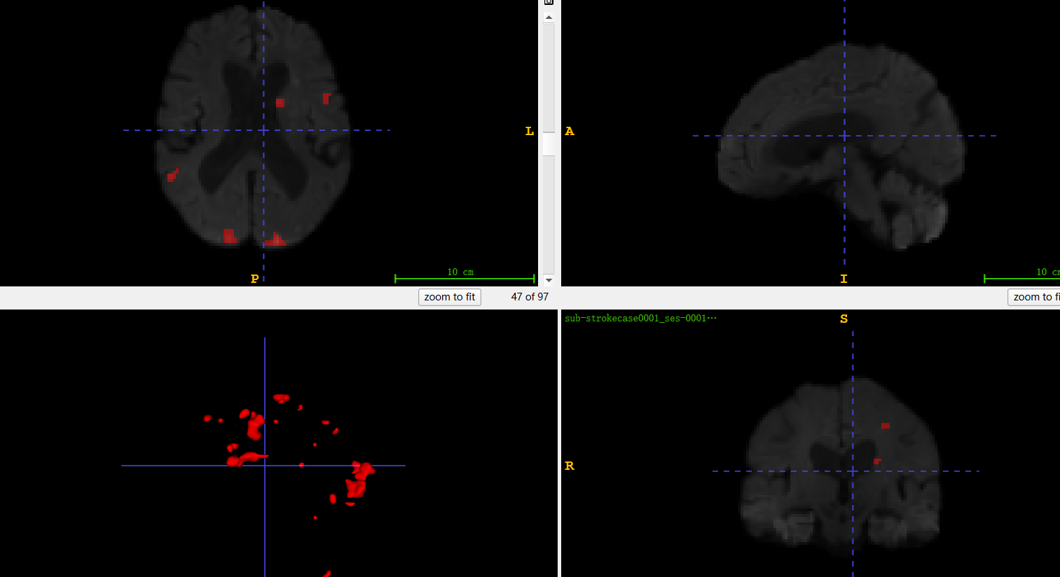 使用SimpleITK批量计算医学图像分割的mask体积，病灶体积