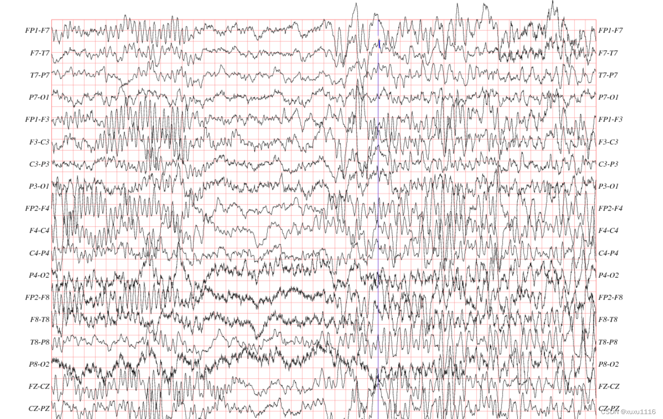 第三课：脑电图波形的分析和识别_脑电图位相倒置_zengleilee的博客-CSDN博客