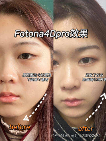 欧洲之星Fotona 4dpro效果，有效果吗？