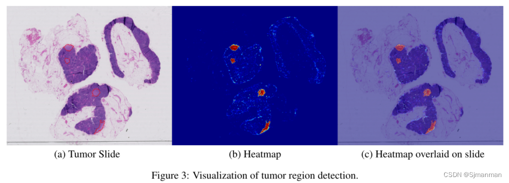 Deep Learning for Identifying Metastatic Breast Cancer识别转移性乳腺癌_论文笔记