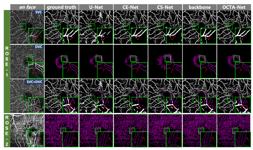 OCTA数据集（Rose）+ OCTA-Net