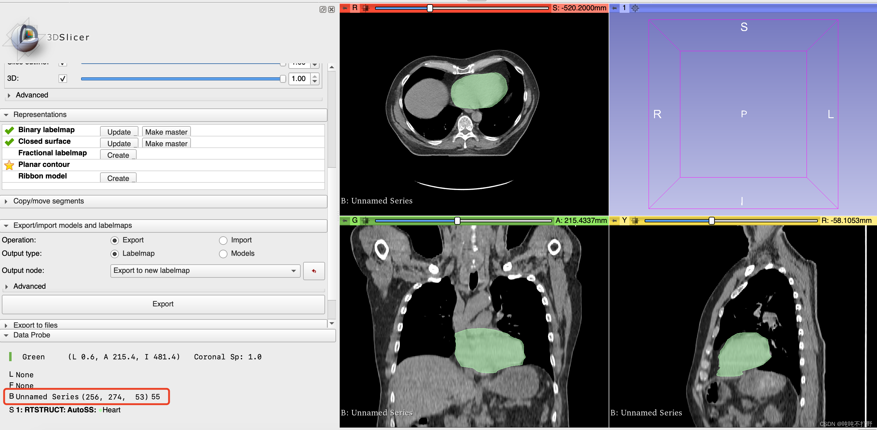 Rtstruct Annotations DICOM-RT struct在python中显示mask以及使用3d Slicer转换为nii_rtstruct_吨吨不打野的博客-CSDN博客