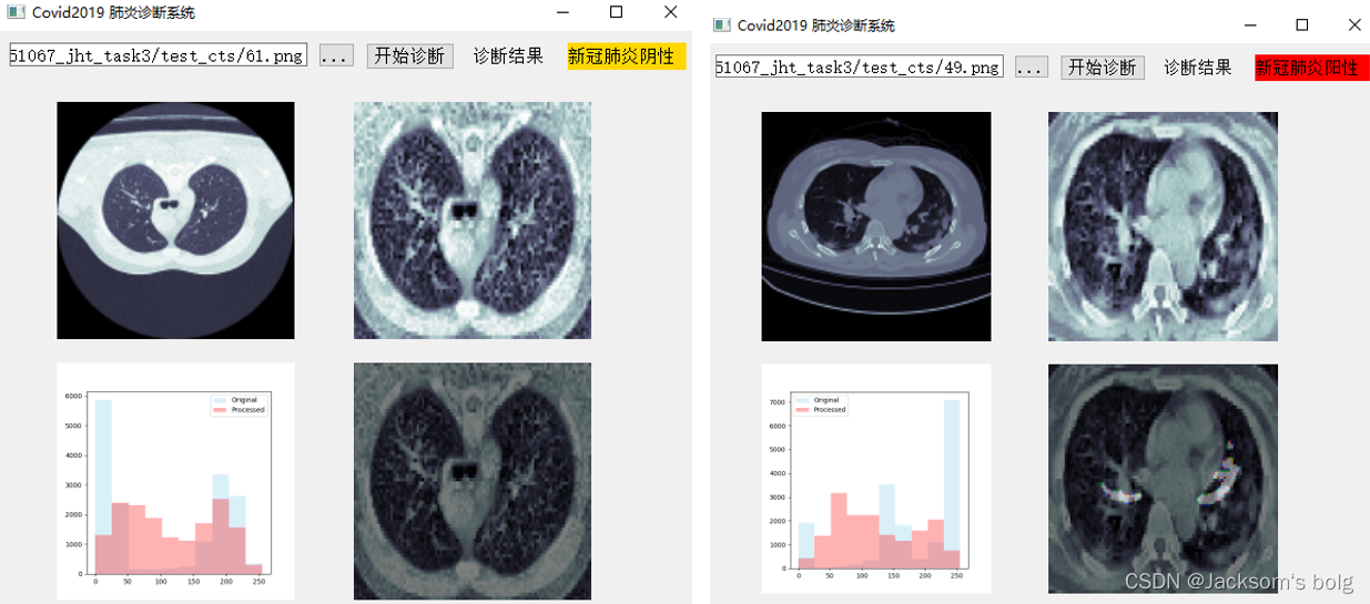 【计算机视觉】新冠肺炎COVID-19 CT影片阳性检测，感染区域分割，肺部分割，智慧医疗实践，医疗影像处理示例