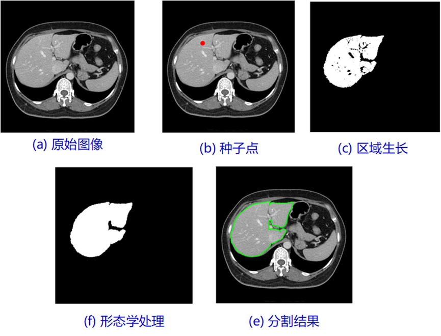 基于阈值预分割的区域生长分割法研究-含Matlab代码