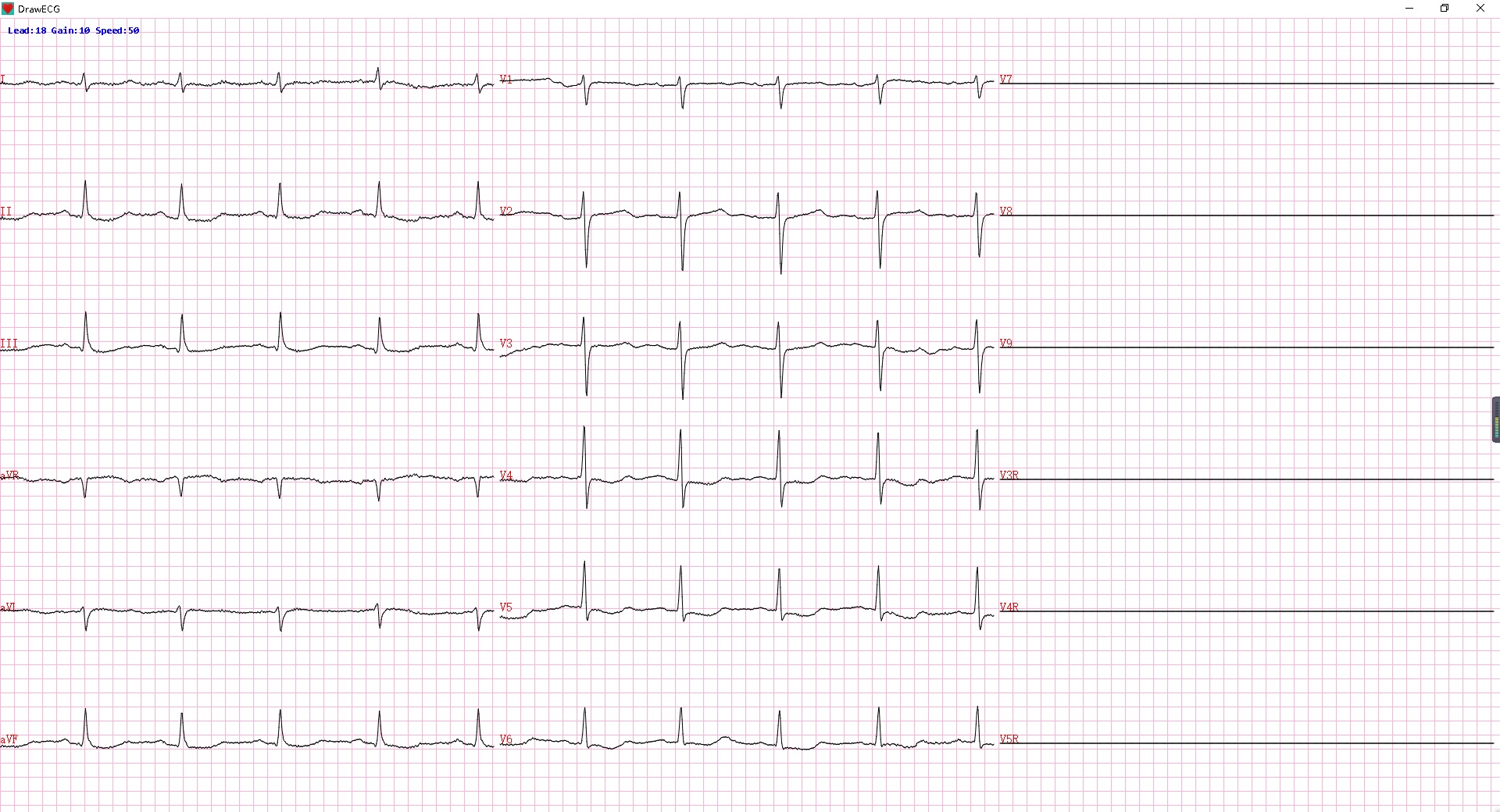 18导联心电图