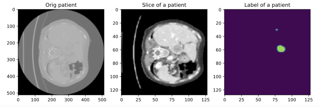 使用 Monai 和 PyTorch 预处理 3D Volumes以进行肿瘤分割