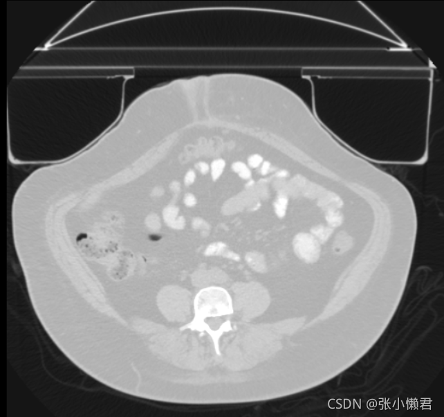 DICOM的理解与学习2_ct图像如何去除床印记-CSDN博客