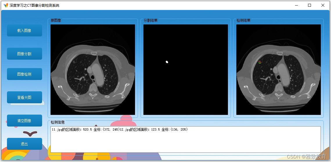 深度学习之基于CT影像图像分割检测系统