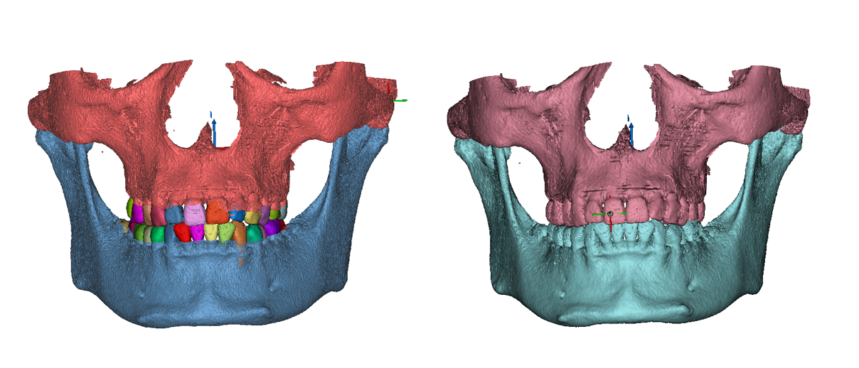 【Mimics】口腔牙齿三维重建