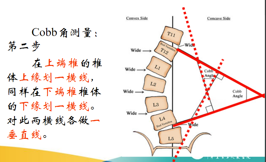 cobb角测量图解图片