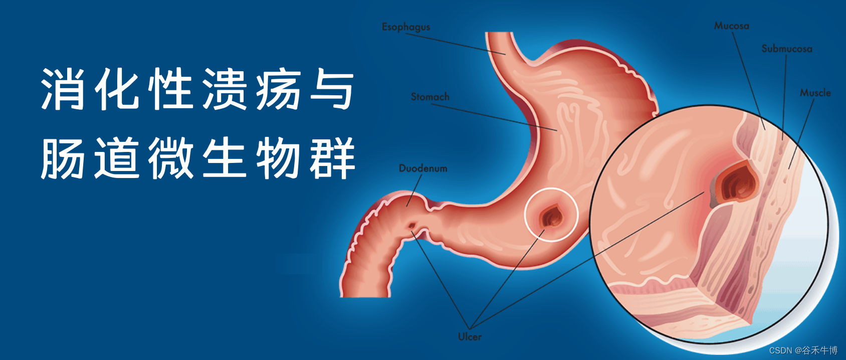 消化性溃疡与胃肠道微生物群