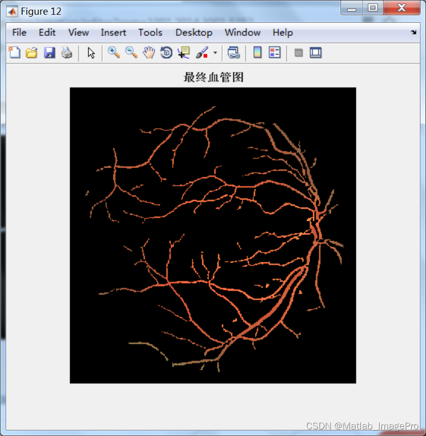 基于Matlab的眼底图像血管分割，Matlab实现
