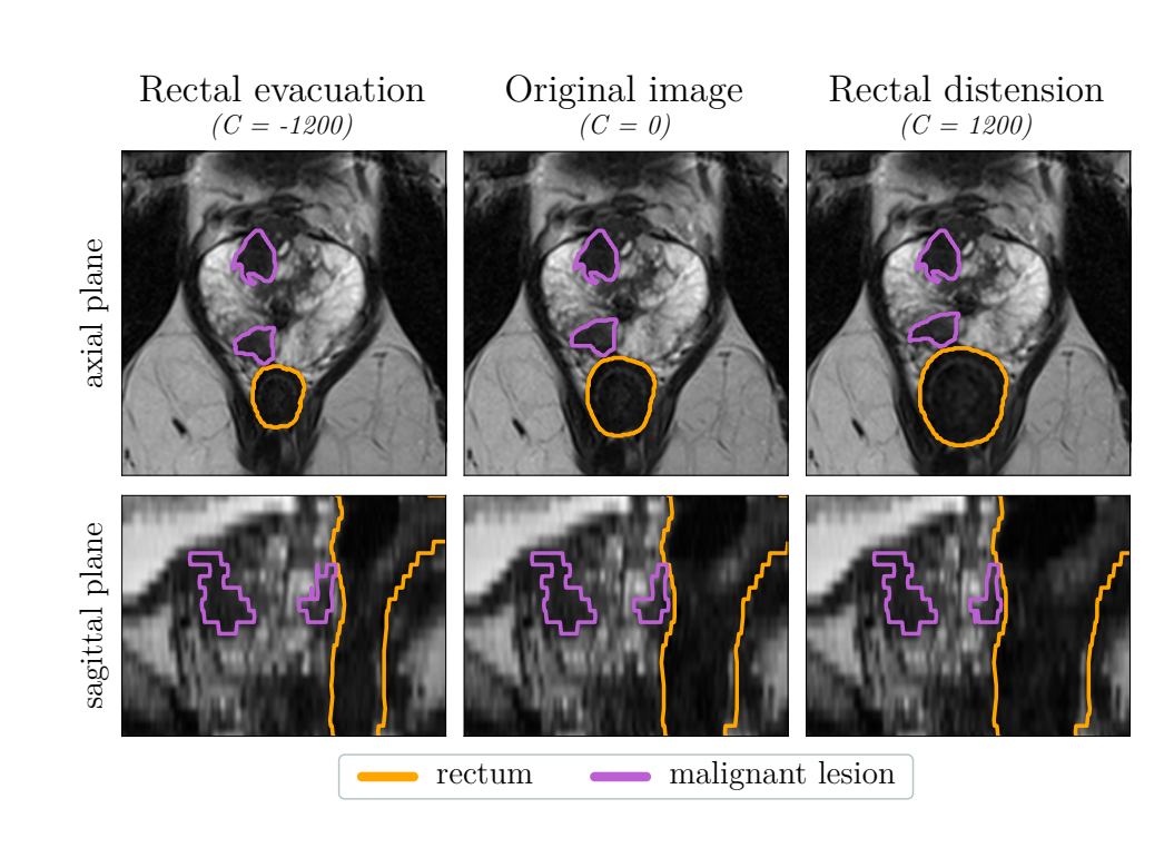 前列腺数据增强】基于解剖学的变形方法-CSDN博客