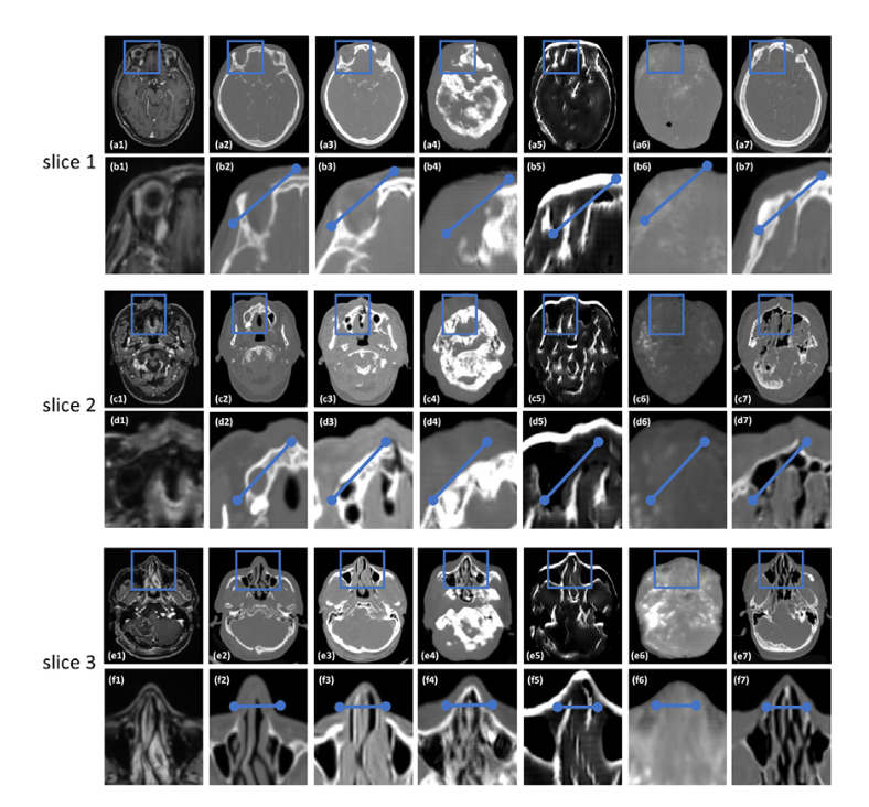 跨模态图像翻译：使用具有感知监督的多生成网络合成MR脑图像的CT图像