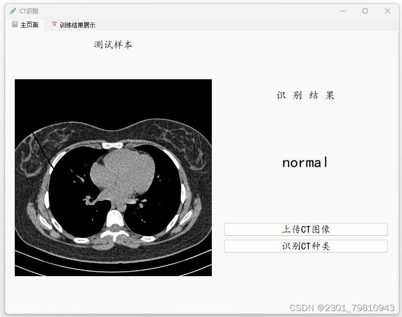 深度学习基于Tensorflow卷积神经网络VGG16的CT影像识别分类