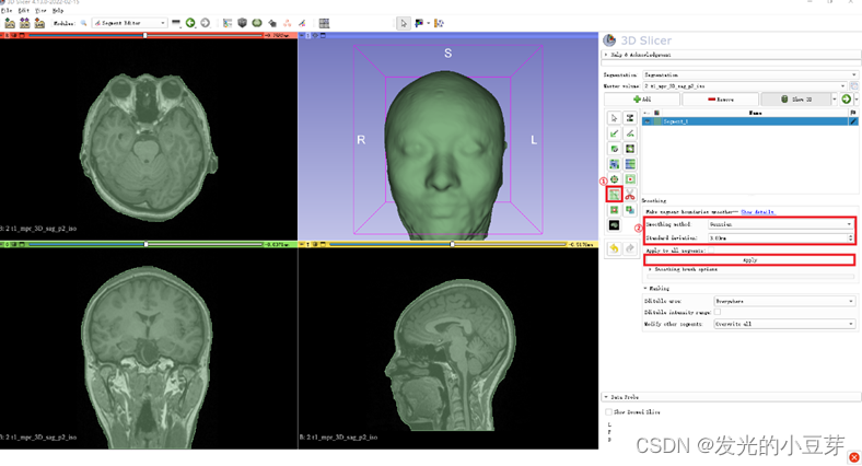 3D Slicer 制作个性化面具并导出保存为3D打印文件_3dslicer皮肤建模-CSDN博客