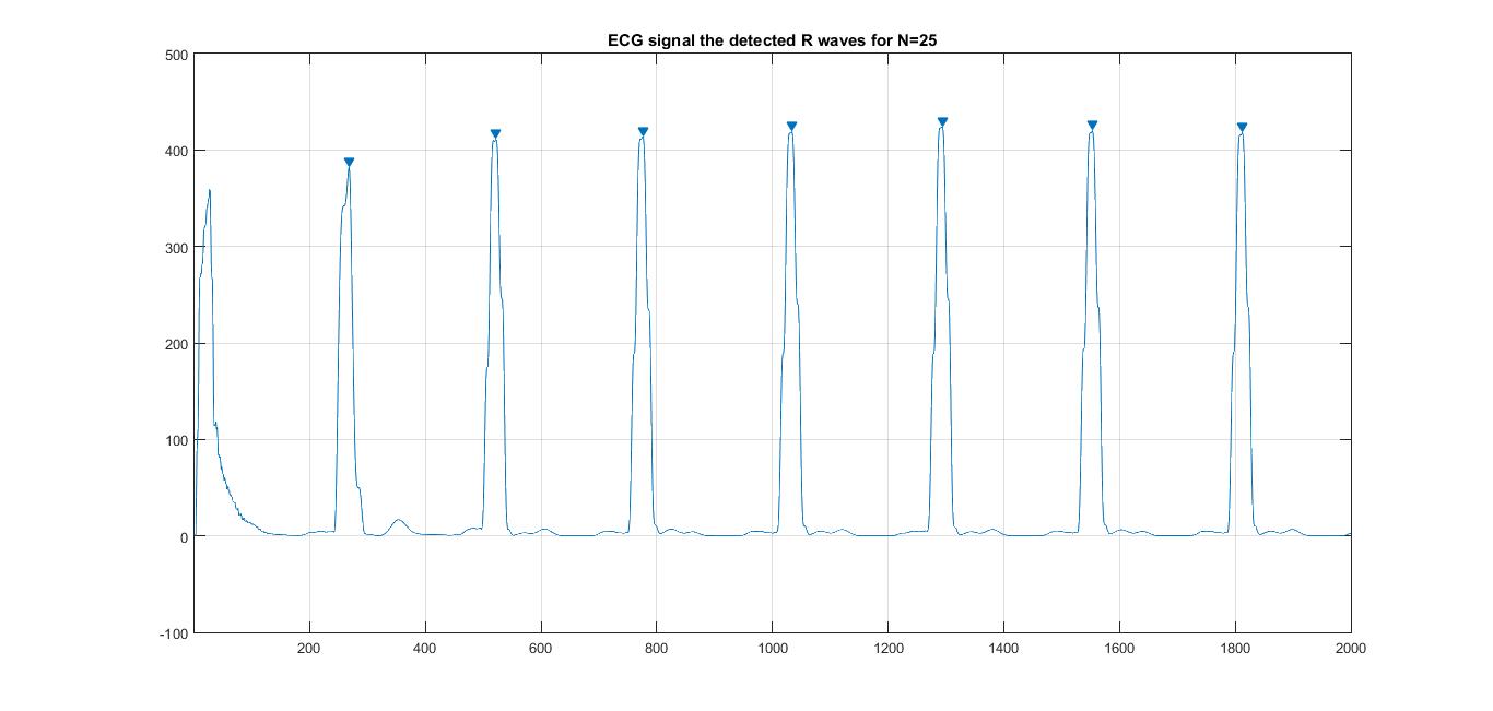 【信号处理】心电信号传统R波检测定位典型方法实现（matlab）