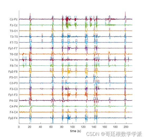 MATLAB环境下基于NLEO的算法的脑电EEG信号自发活动瞬态检测