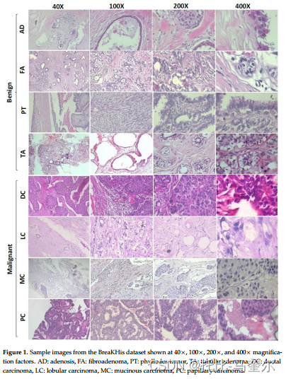 基于Swin Transformers的乳腺癌组织病理学图像多分类