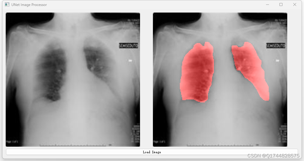 深度学习之基于Unet肺部CT图像分割项目