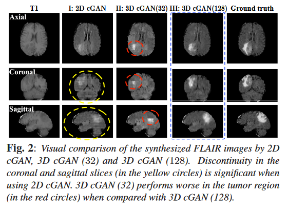 基于3D-CGAN的跨模态MR<span style='color:red;'>脑</span><span style='color:red;'>肿瘤</span><span style='color:red;'>分割</span>图像合成