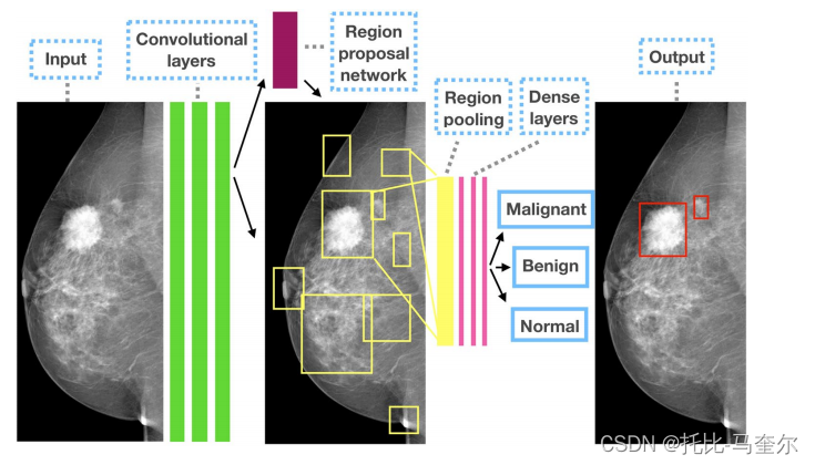 5.12.1 Detecting and classifying lesions in mammograms with Deep Learning