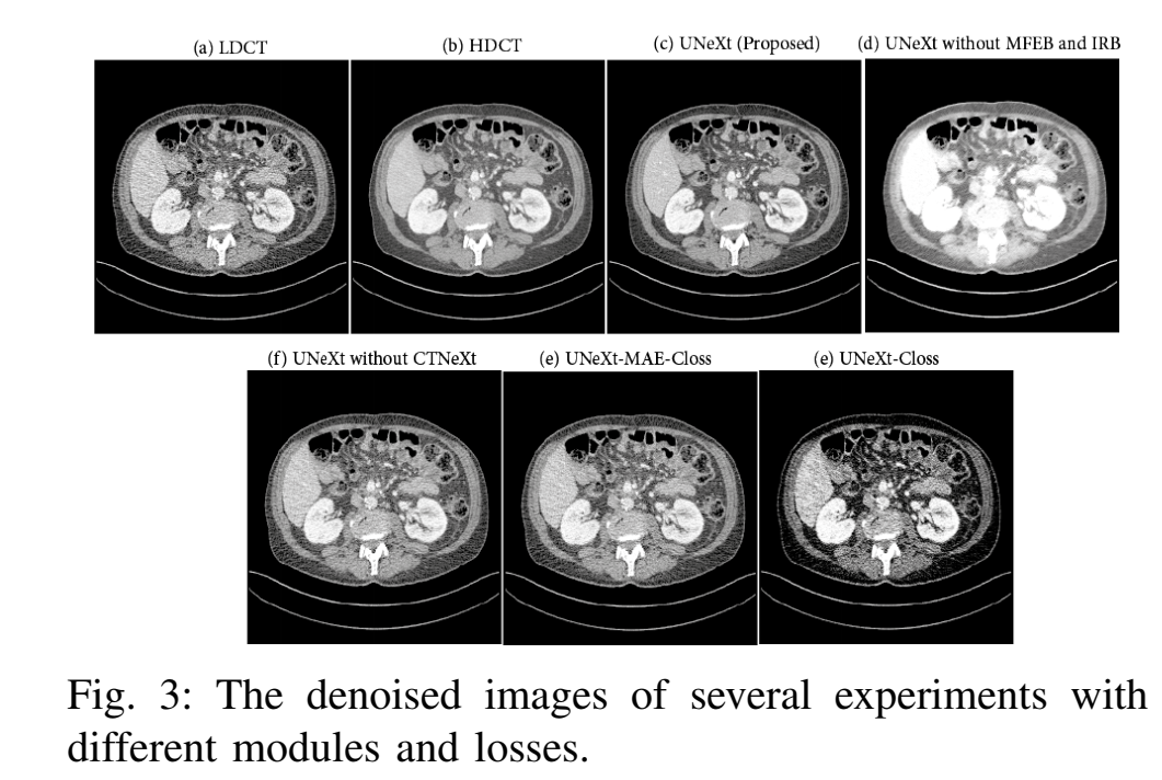 UNeXt: a Low-Dose CT denoising UNet model with the modified ConvNeXt block