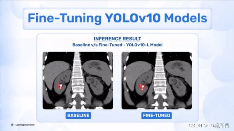 在自定义数据集上对 YOLOv10 模型进行微调以检测肾结石