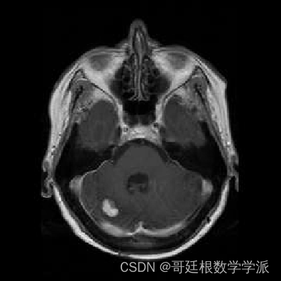 MATLAB环境下基于离散小波变换和主成分平均的医学图像融合方法