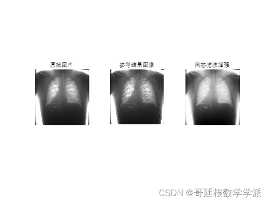 MATLAB环境下基于同态滤波方法的医学图像增强