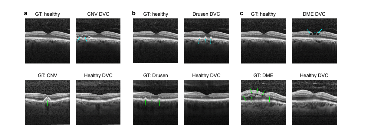 扩散视觉反事实算法 DVC：对抗性鲁棒分类器 + 扩散模型，跨模态对比原始的 fundus 图 VS 生成的 OCT 图