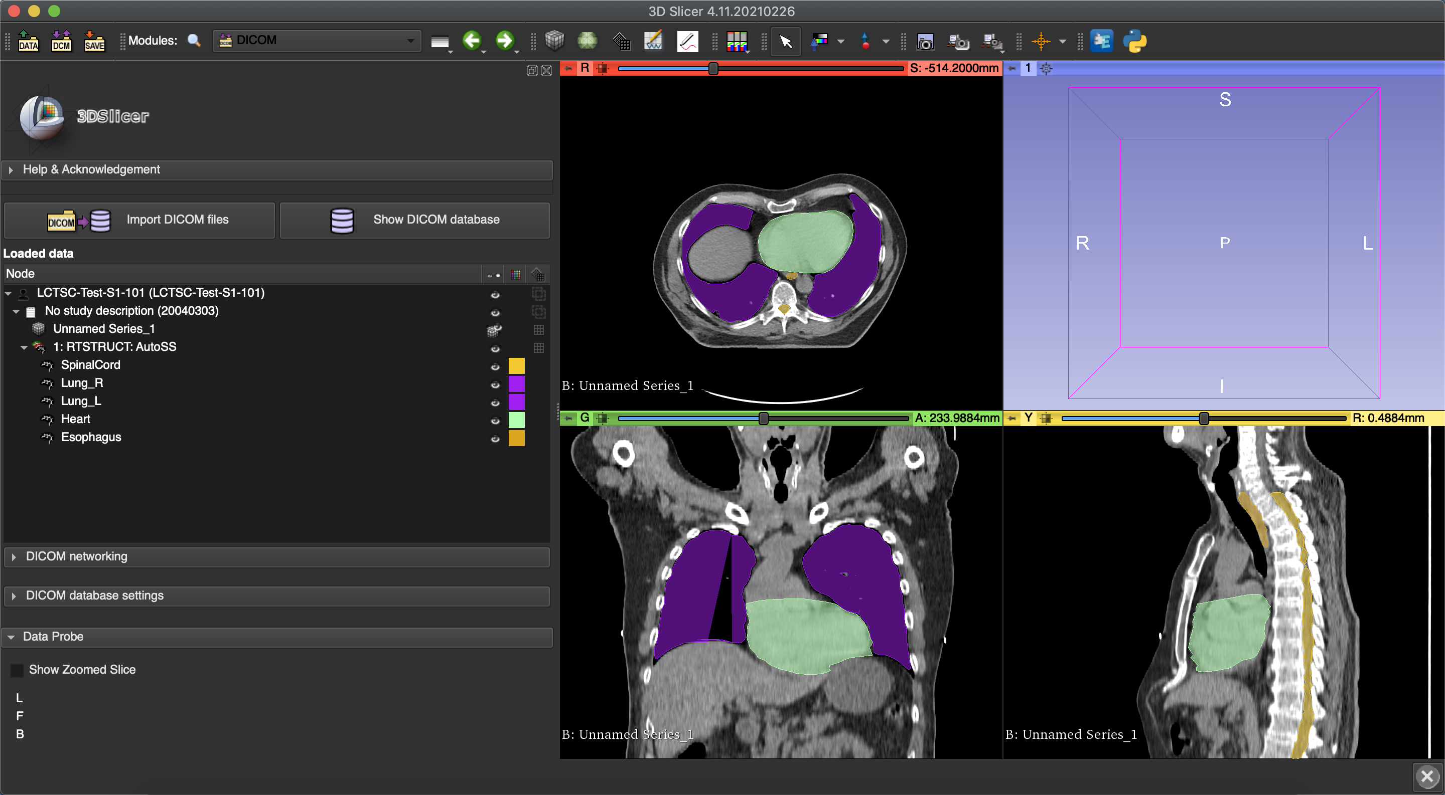 DICOM-RT struct在python中显示mask以及使用3d Slicer转换为nii_吨吨不打野的博客-CSDN博客