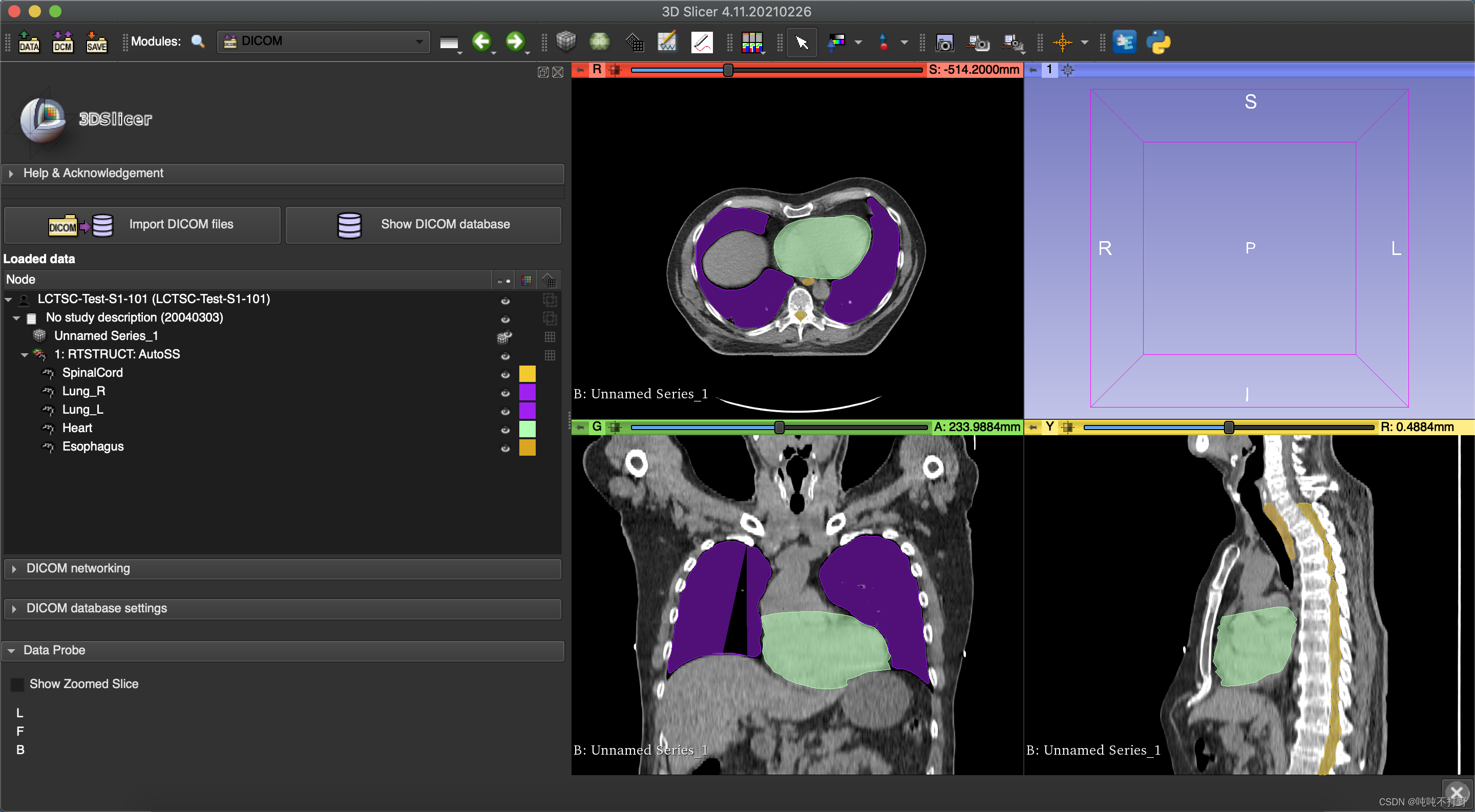 DICOM-RT struct在python中显示mask以及使用3d Slicer转换为nii_吨吨不打野的博客-CSDN博客