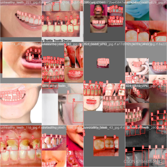 基于深度学习的高精度牙齿健康检测识别系统（PyTorch+Pyside6+YOLOv5模型）