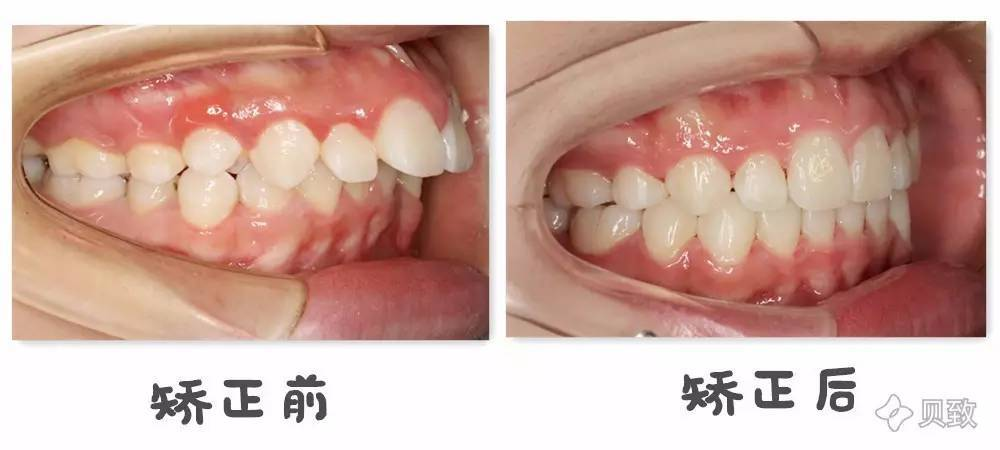 牙齿矫形教训和洗牙知识_kq88口腔博客-CSDN博客