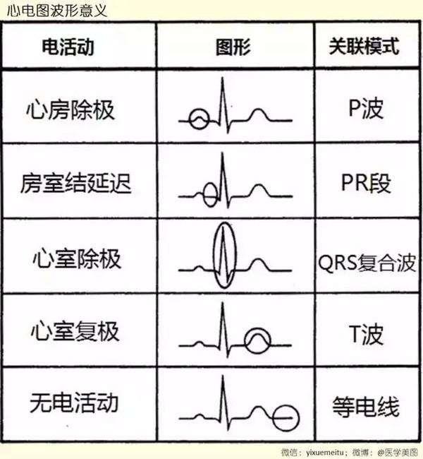 11种异常心电图口诀图片