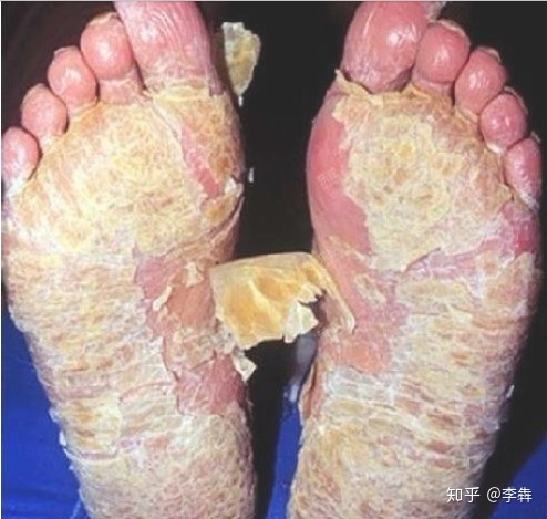 httpunhandledexception_脚气的4种类型和10种级别,来对号入座啦.