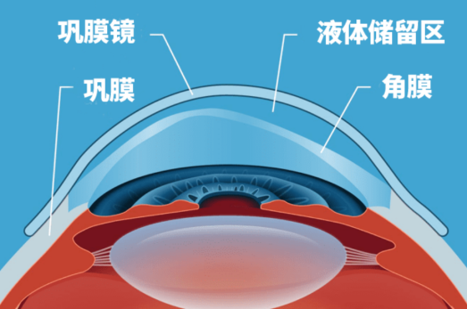 成都爱尔林江院长解析巩膜镜是什么？它适合哪些人群