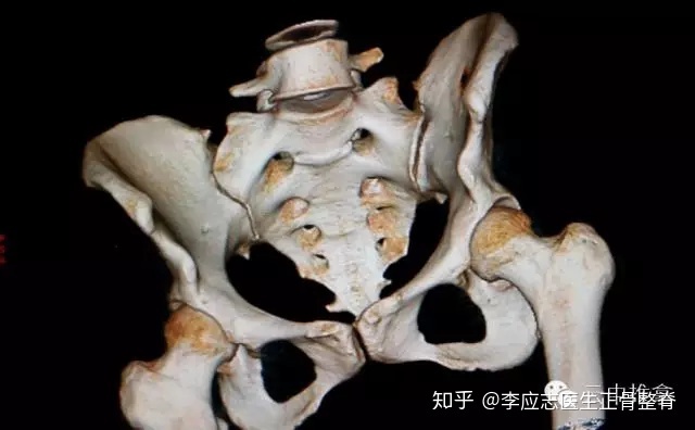 髂嵴最高点在哪里_骶髂关节错位的科普